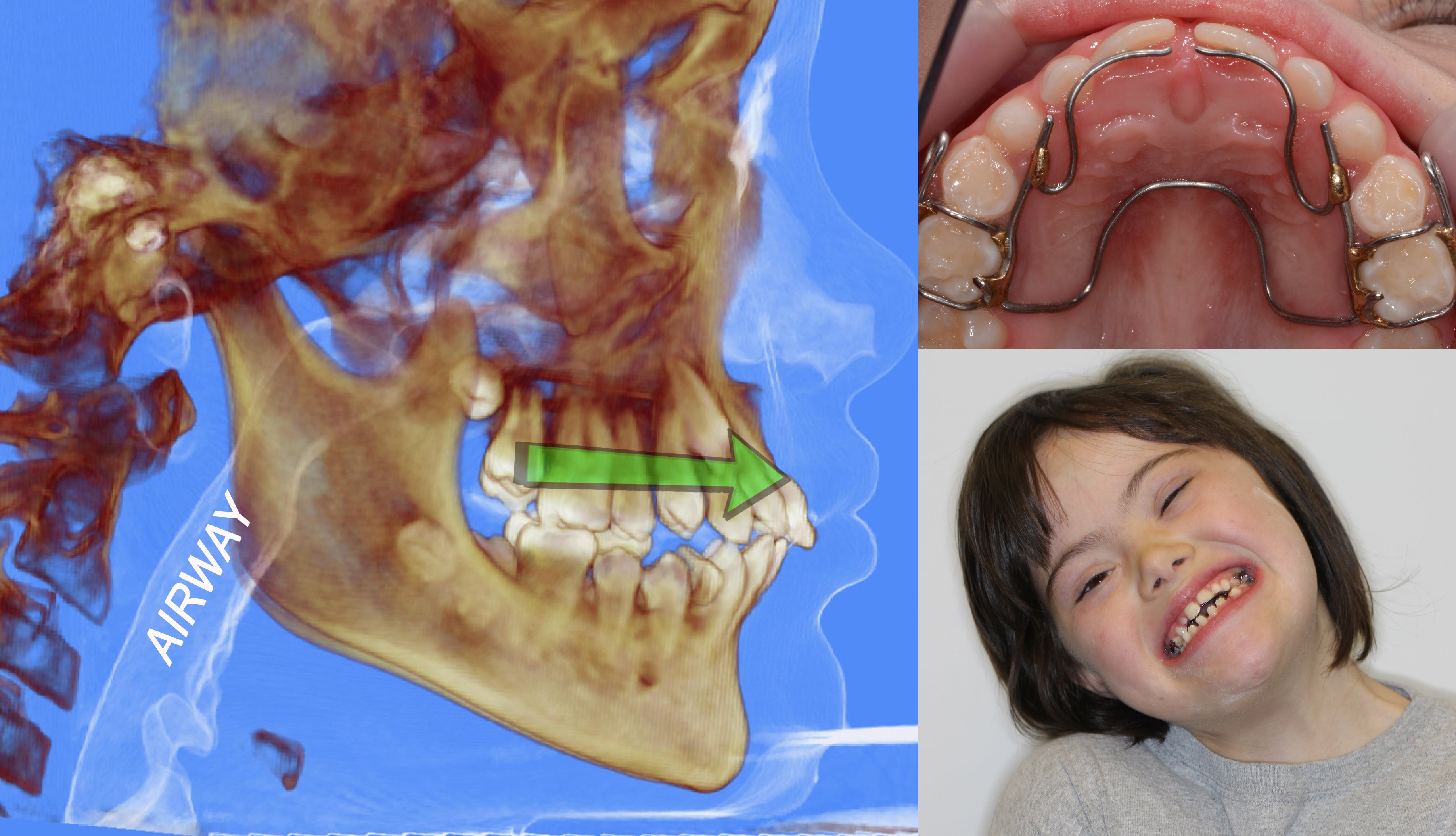 Airway Apnea Orthodontics and OPT corso online 0.3 CEU